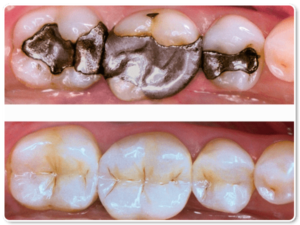 Southland Dental Surgery - Teeth Fillings