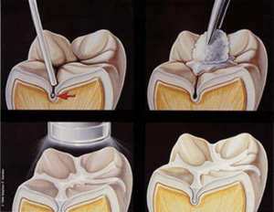 Southland Dental Surgery - Fissures Sealant