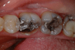 Southland Dental Surgery - Gold Crown Before