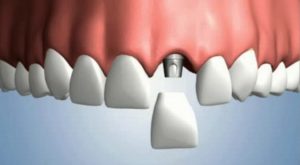 Southland Dental Surgery - Implant Restoration