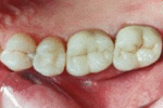 Southland Dental Surgery - Porcelain Crown After