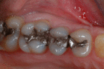Southland Dental Surgery - Porcelain Crown Before