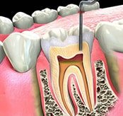 Southland Dental - Root Canal Treatment