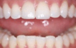 Southland Dental Surgery - Tooth Colour Restoration After