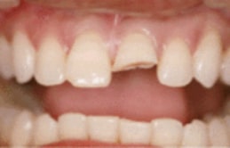Southland Dental Surgery - Tooth Colour Restoration Before